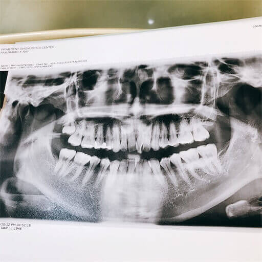 歯列矯正のレントゲン写真